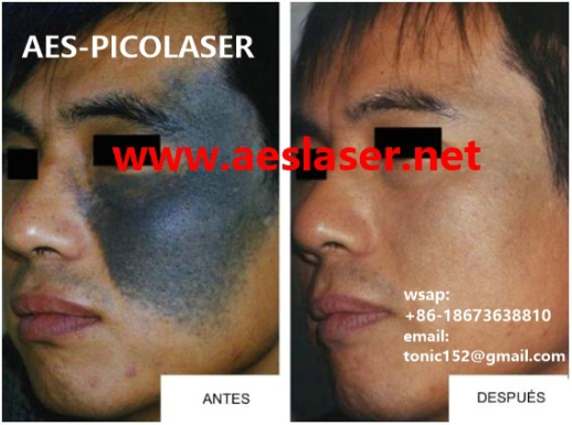 Birthmark removal by AESPICOLASER