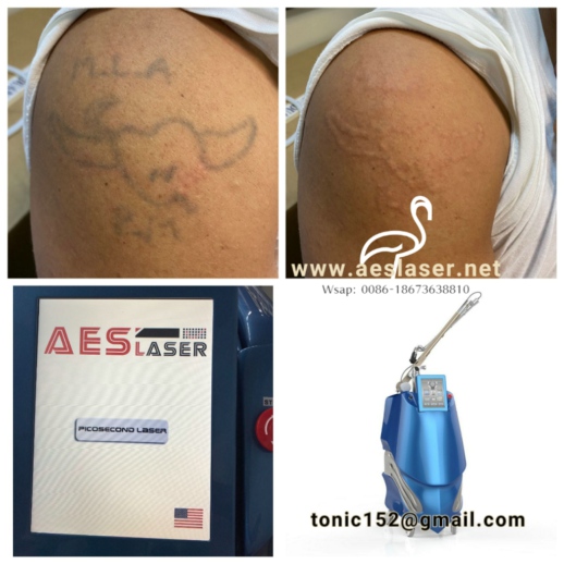 Tattoo removal by AES-PICOLASER